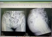 Diduga Lalai dan Asal Periksa, Pelayanan RSUD Kota Tanjungpinang Dikeluhkan Keluarga Pasien